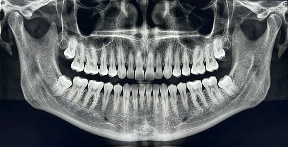 CBCT dental scan